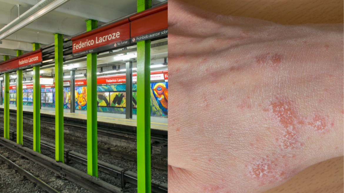 B line scabies infestation Buenos Aires subte subway